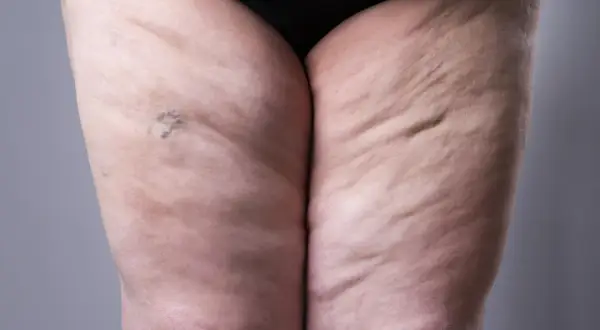 Uda uda z widocznym cellulitem i pajęczynami naczyniowymi. Szukamy naturalnych metod, jak zioła na obrzęk lipidowy.