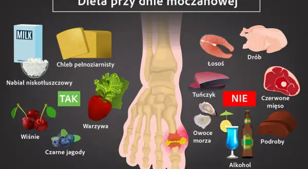 Dieta przy dnie moczanowej: co pić? Zalecane: nabiał niskotłuszczowy, chleb pełnoziarnisty, warzywa, wiśnie, czarne jagody. Unikaj: drobiu, łososia, tuńczyka, czerwonego mięsa, owoców morza, podrobów, alkoholu.